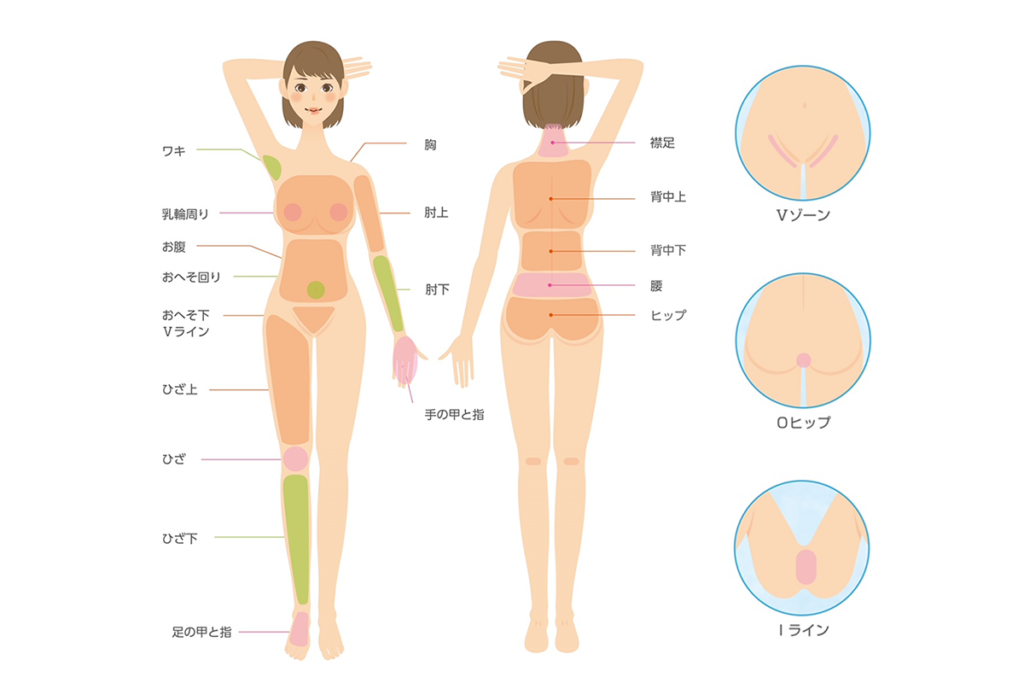 エムビューティークリニック脱毛範囲2