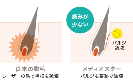 DMTC脱毛機メディオスター痛みが少ない