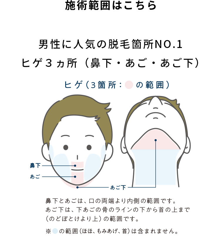 メンズじぶんクリニックヒゲ脱毛範囲