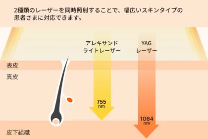 スプレンダーXレーザー